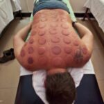 The world’s wackiest and weird spa treatments hot-cupping-spa-experience.jpg
